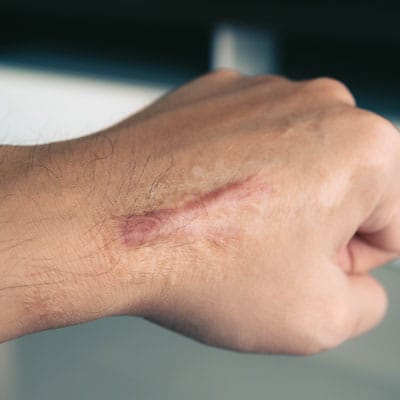 surgical scar on hand